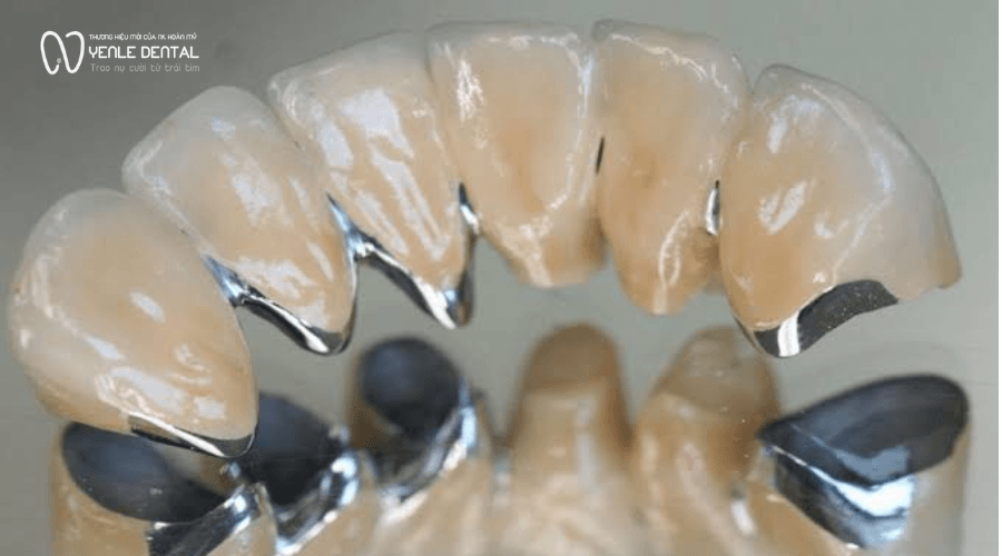 răng sứ kim loại đổi màu theo thời gian
